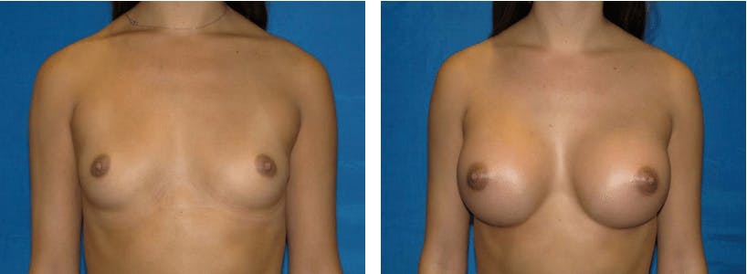 Breast Augmentation Before & After Gallery - Patient 74801860 - Image 1