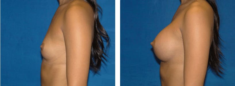Breast Augmentation Before & After Gallery - Patient 74801860 - Image 2