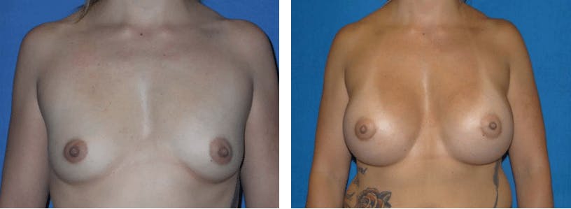 Breast Augmentation Gallery - Patient 74801862 - Image 1