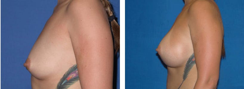 Breast Augmentation Before & After Gallery - Patient 74801862 - Image 2