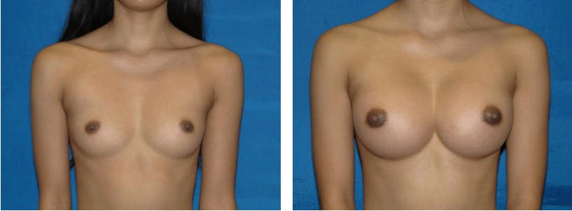 Breast Augmentation Before & After Gallery - Patient 74801864 - Image 1