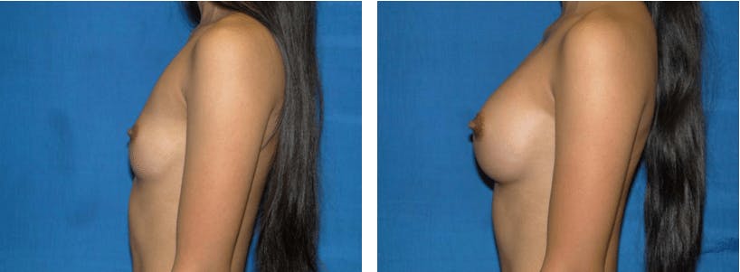 Breast Augmentation Before & After Gallery - Patient 74801864 - Image 2