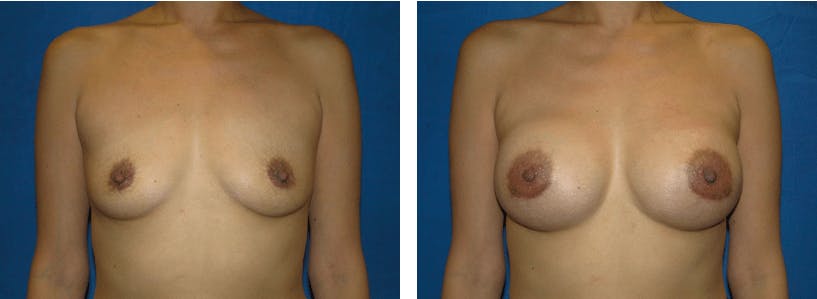 Breast Augmentation Before & After Gallery - Patient 74801865 - Image 1