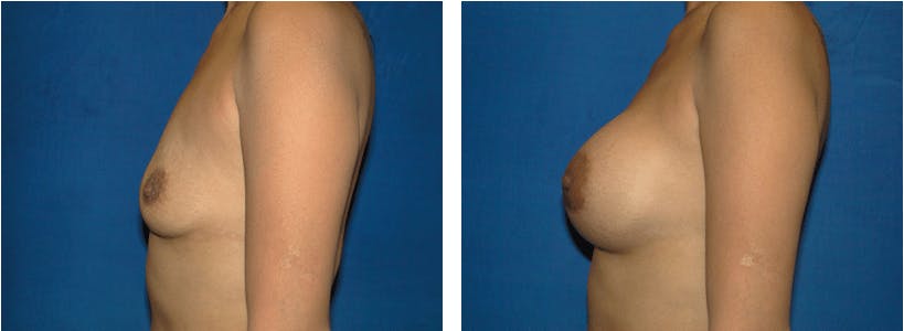 Breast Augmentation Before & After Gallery - Patient 74801865 - Image 2
