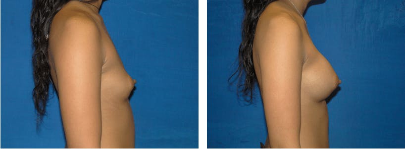 Breast Augmentation Before & After Gallery - Patient 74801866 - Image 2