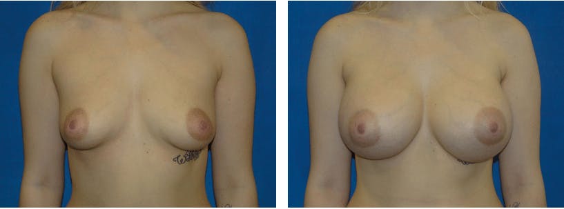 Breast Augmentation Before & After Gallery - Patient 74801867 - Image 1