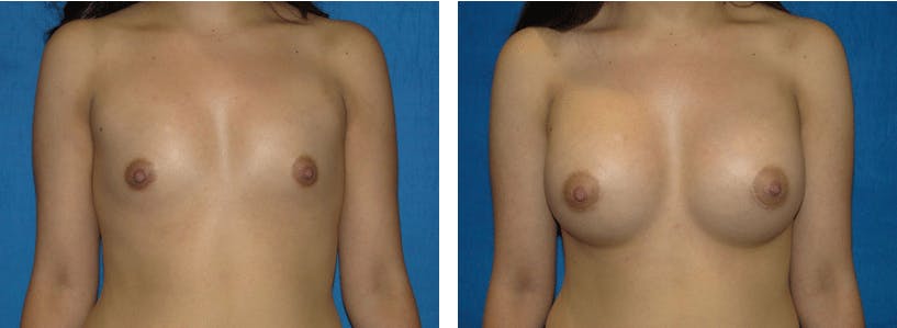 Breast Augmentation Before & After Gallery - Patient 74801868 - Image 1