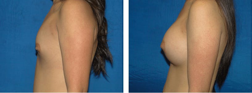 Breast Augmentation Before & After Gallery - Patient 74801868 - Image 2