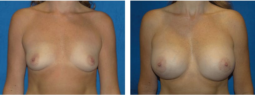 Breast Augmentation Before & After Gallery - Patient 74801869 - Image 1