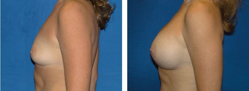 Breast Augmentation Before & After Gallery - Patient 74801869 - Image 2
