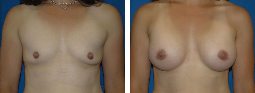 Breast Augmentation Before & After Gallery - Patient 74801870 - Image 1