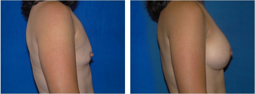 Breast Augmentation Before & After Gallery - Patient 74801870 - Image 2