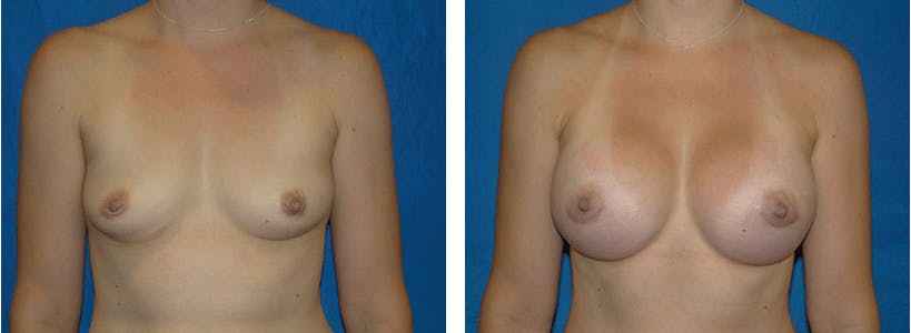 Breast Augmentation Before & After Gallery - Patient 74801871 - Image 1