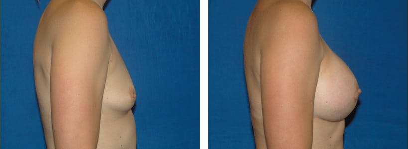 Breast Augmentation Before & After Gallery - Patient 74801871 - Image 2