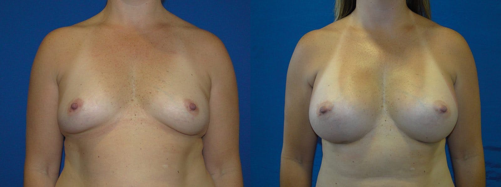 Breast Augmentation Before & After Gallery - Patient 74801878 - Image 1