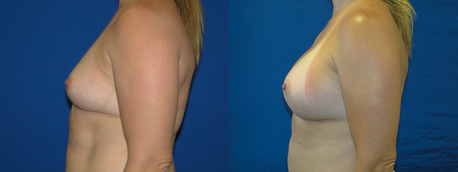 Breast Augmentation Gallery - Patient 74801878 - Image 2