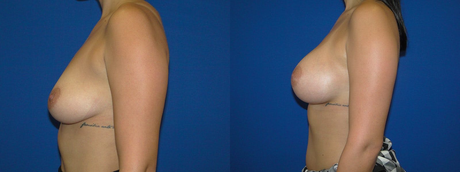 Breast Augmentation Before & After Gallery - Patient 74801880 - Image 2