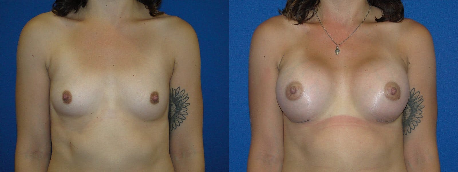 Breast Augmentation Before & After Gallery - Patient 74801881 - Image 1
