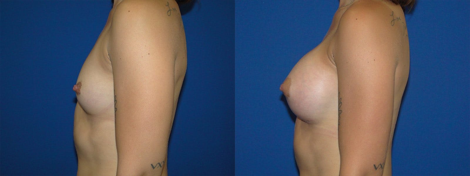 Breast Augmentation Before & After Gallery - Patient 74801881 - Image 2