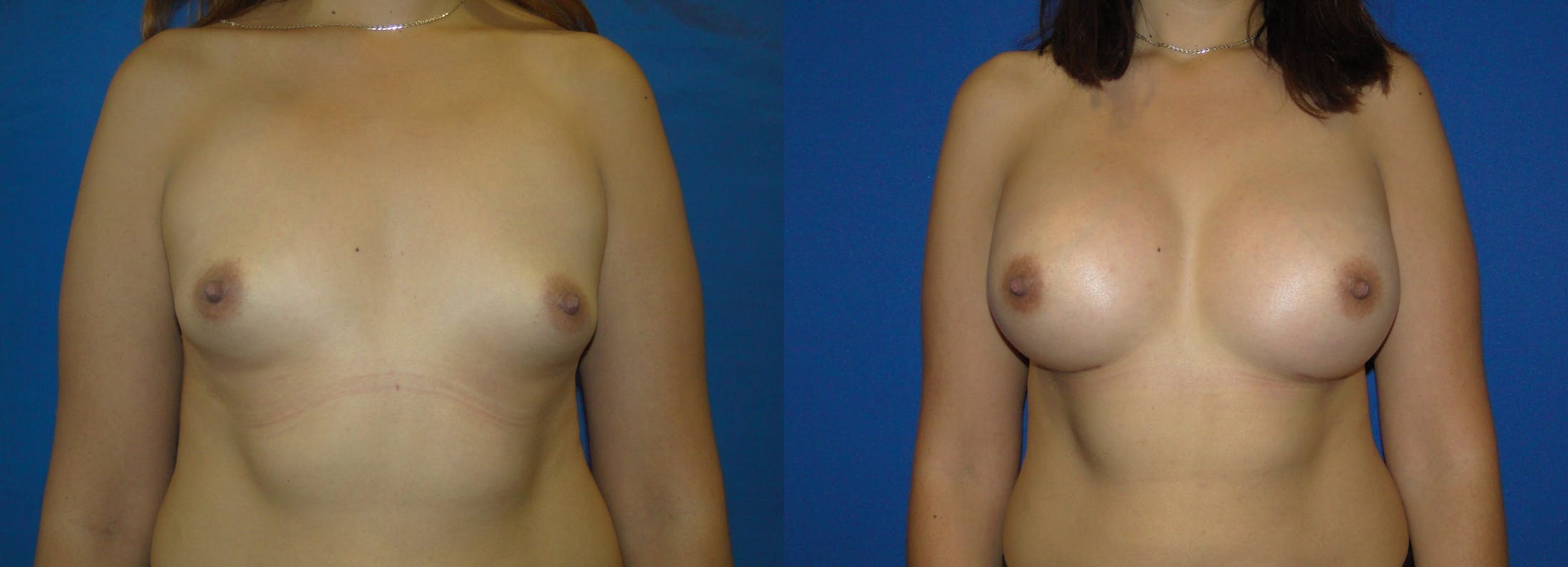 Breast Augmentation Before & After Gallery - Patient 74801883 - Image 1