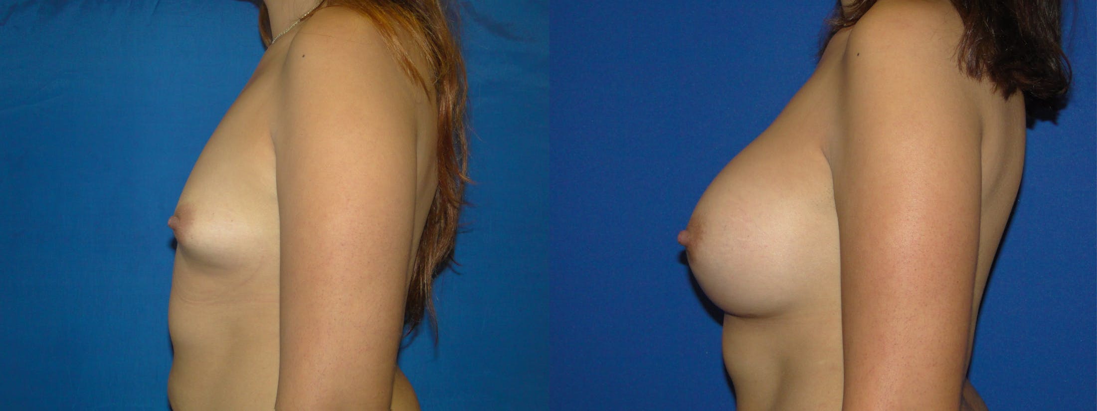 Breast Augmentation Before & After Gallery - Patient 74801883 - Image 2