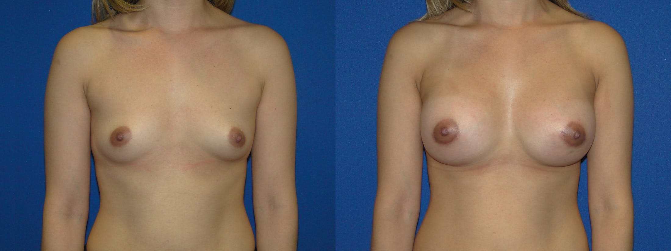 Breast Augmentation Before & After Gallery - Patient 74801884 - Image 1