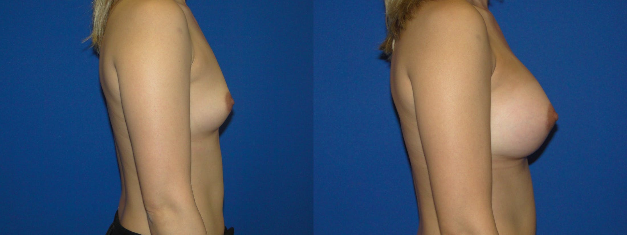 Breast Augmentation Before & After Gallery - Patient 74801884 - Image 2