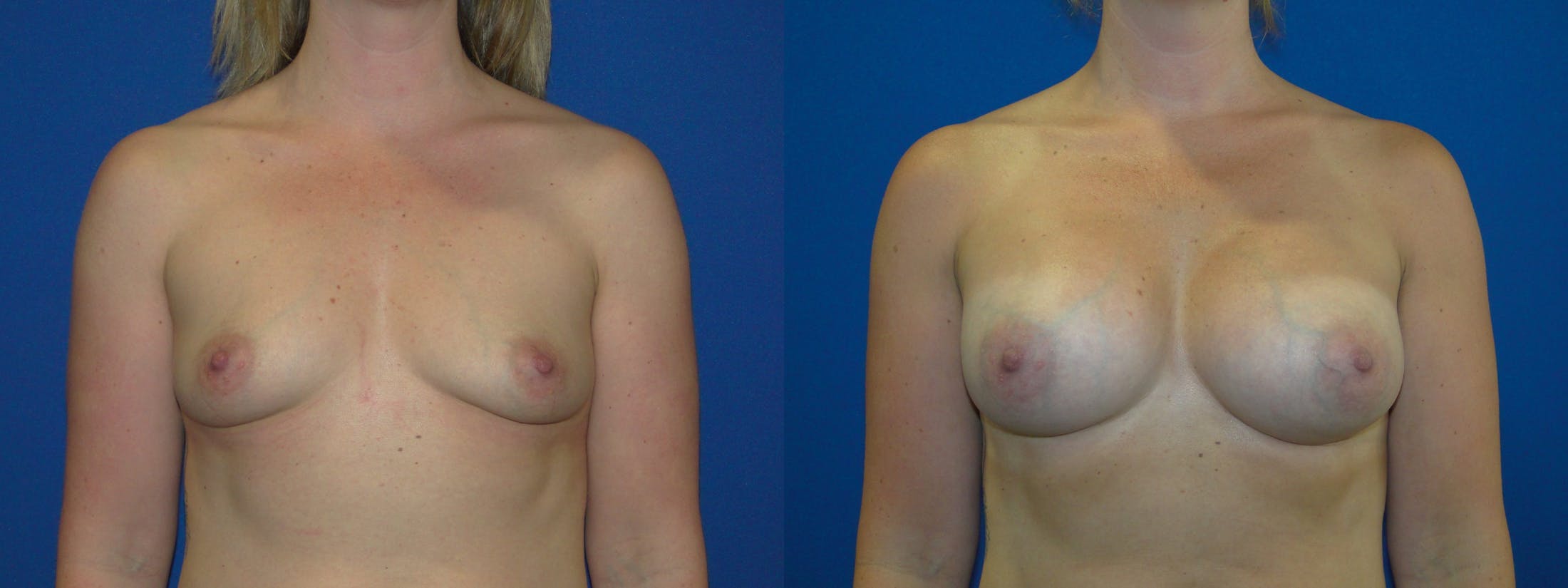 Breast Augmentation Before & After Gallery - Patient 74801885 - Image 1