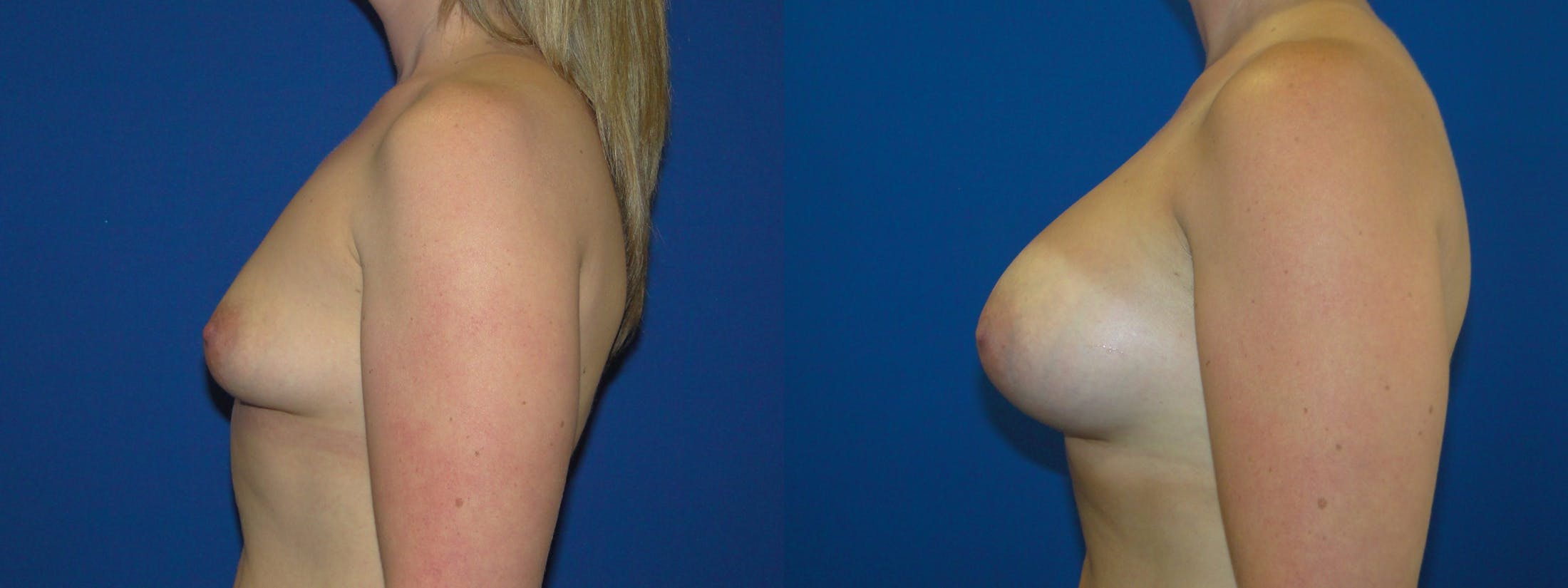 Breast Augmentation Gallery - Patient 74801885 - Image 2