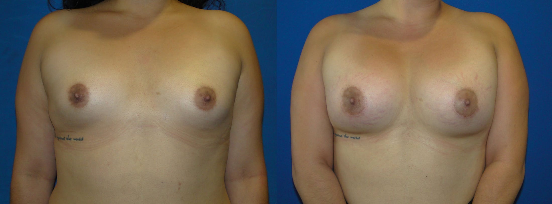 Breast Augmentation Before & After Gallery - Patient 74801886 - Image 1