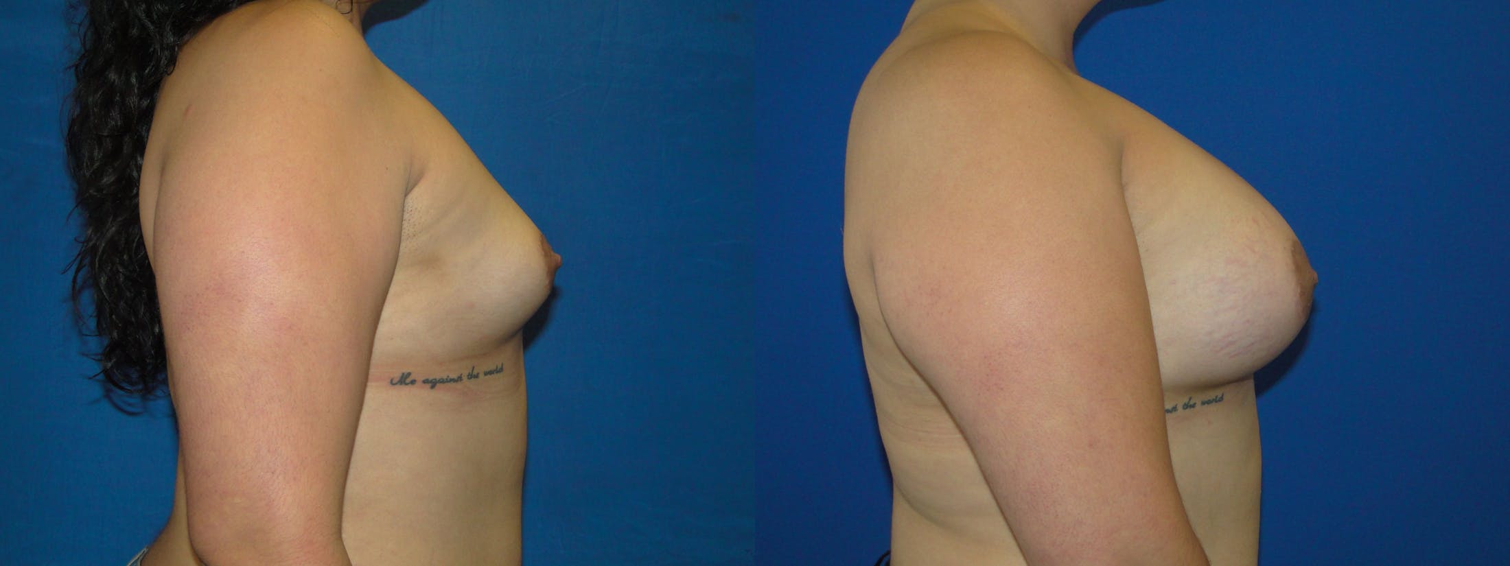 Breast Augmentation Before & After Gallery - Patient 74801886 - Image 2