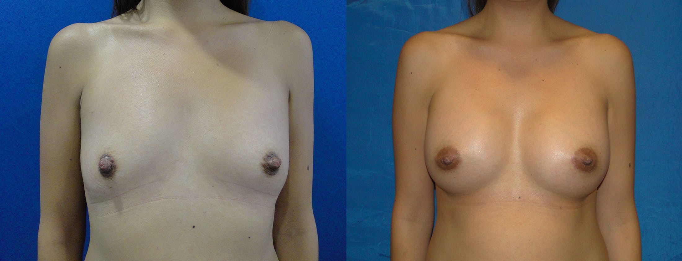 Breast Augmentation Before & After Gallery - Patient 74801887 - Image 1