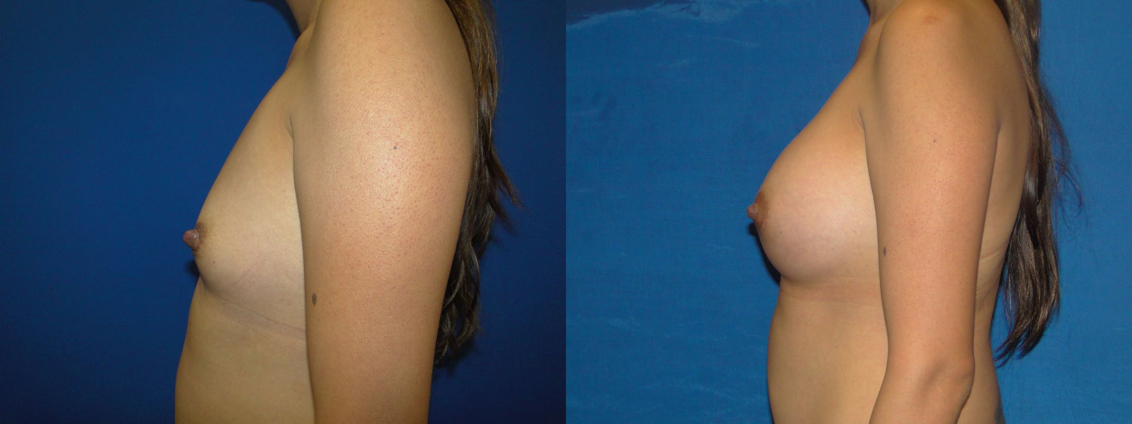 Breast Augmentation Before & After Gallery - Patient 74801887 - Image 2