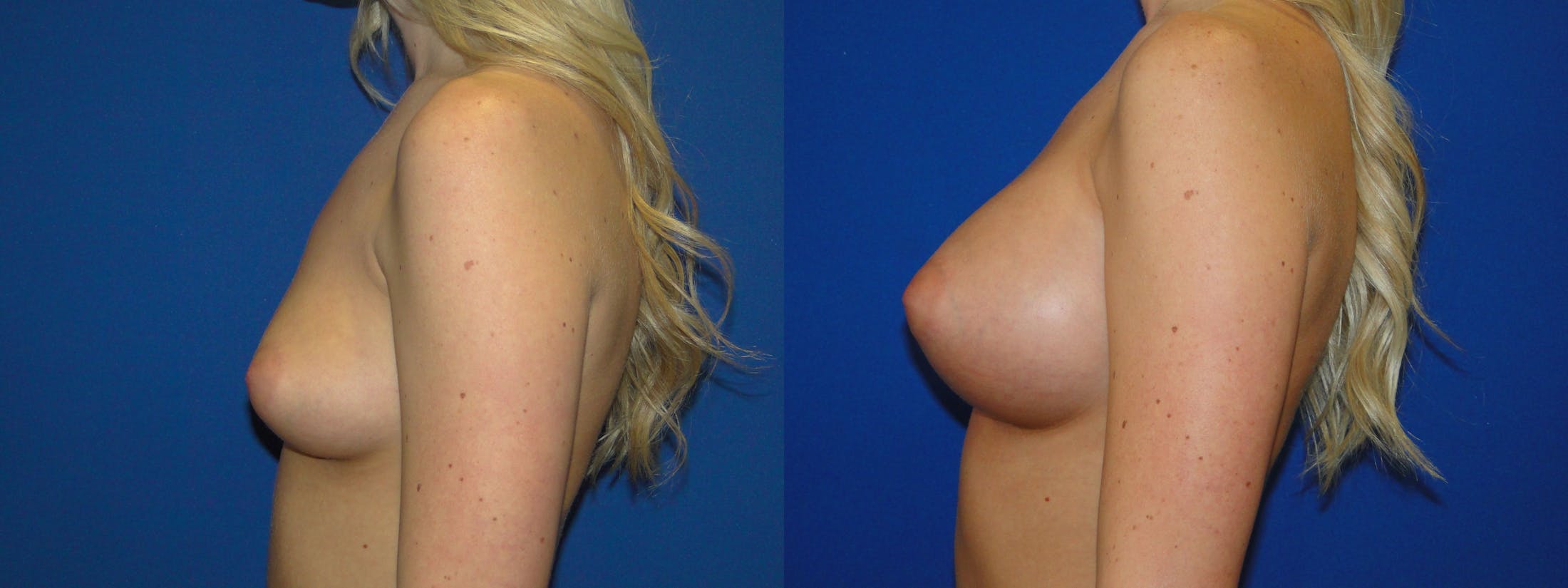 Breast Augmentation Before & After Gallery - Patient 74818575 - Image 2
