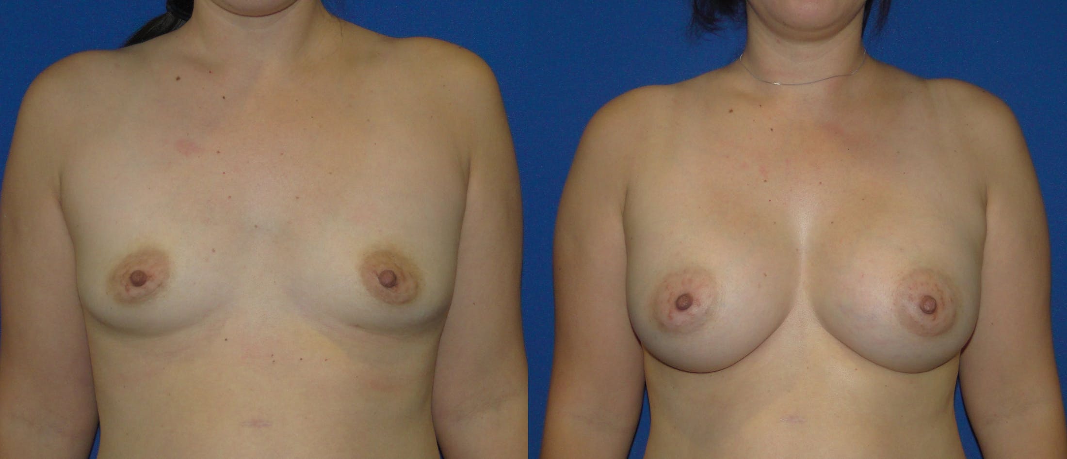 Breast Augmentation Before & After Gallery - Patient 74818576 - Image 1