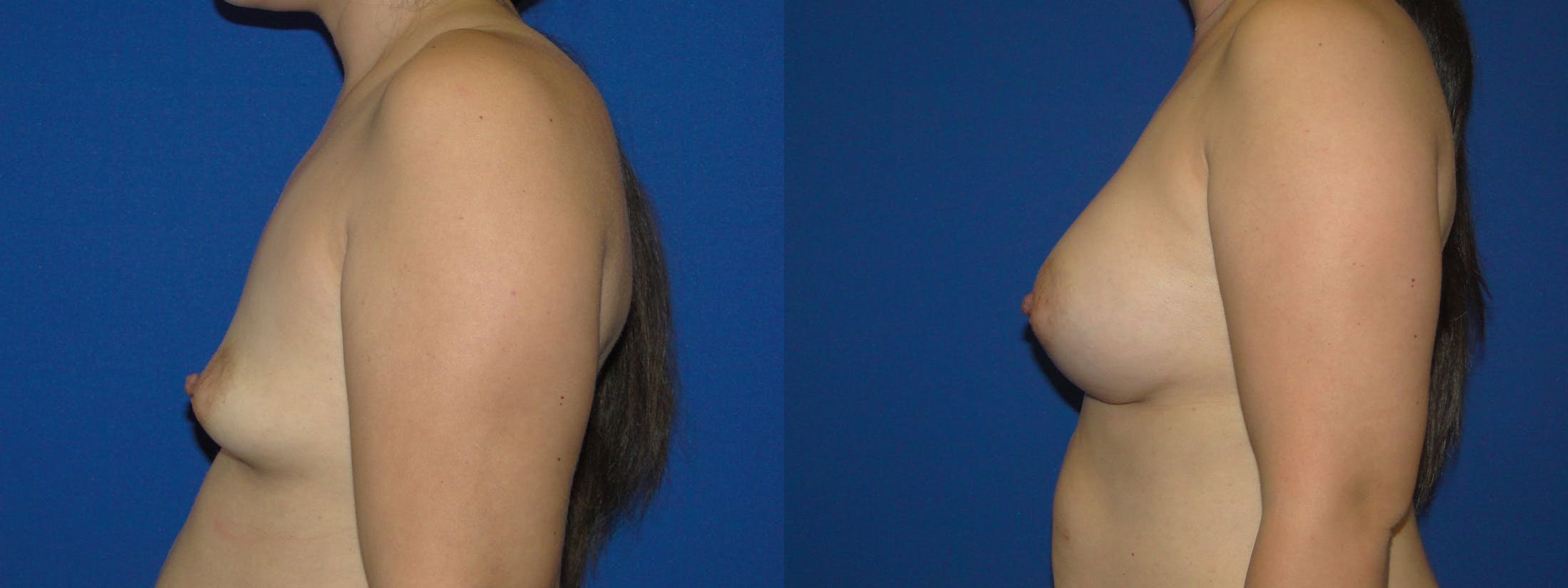 Breast Augmentation Before & After Gallery - Patient 74818576 - Image 2