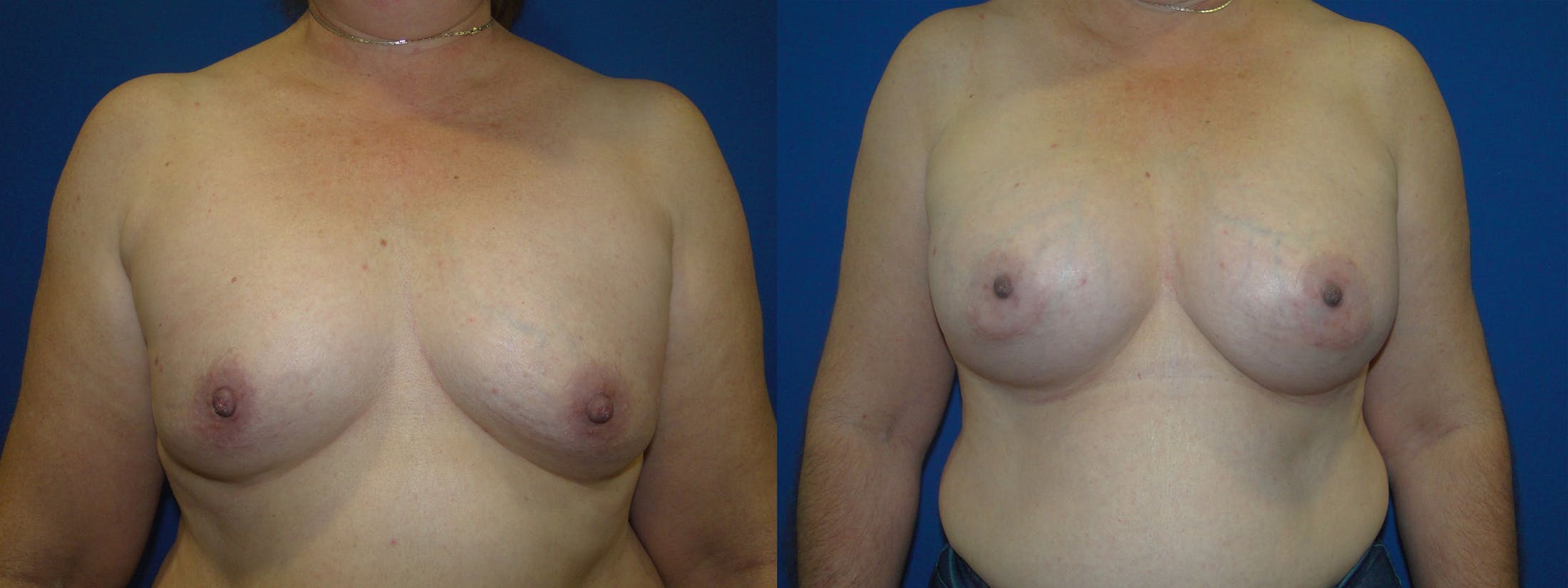Breast Augmentation Before & After Gallery - Patient 74818579 - Image 1