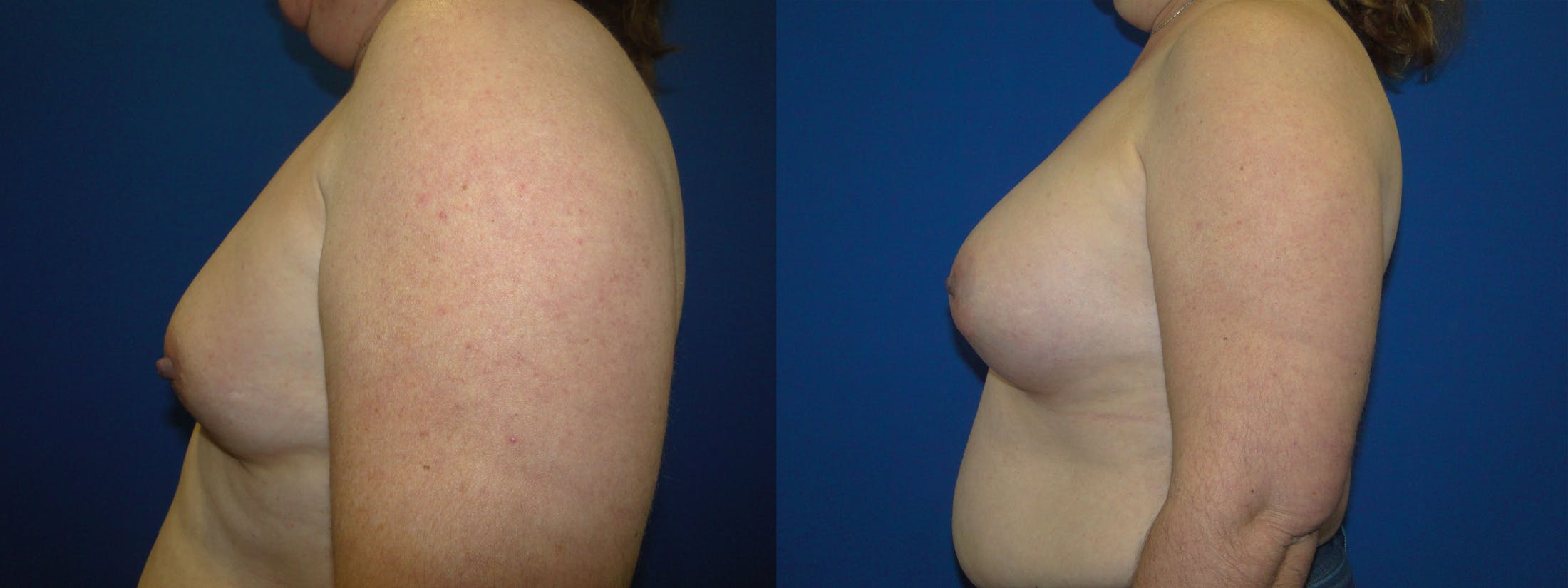 Breast Augmentation Before & After Gallery - Patient 74818579 - Image 2