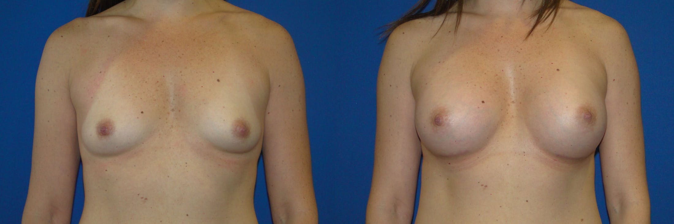 Breast Augmentation Before & After Gallery - Patient 74818580 - Image 1