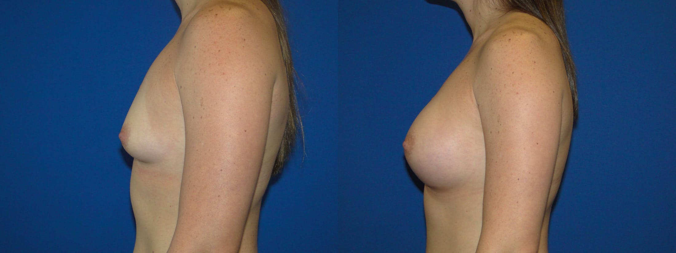 Breast Augmentation Before & After Gallery - Patient 74818580 - Image 2