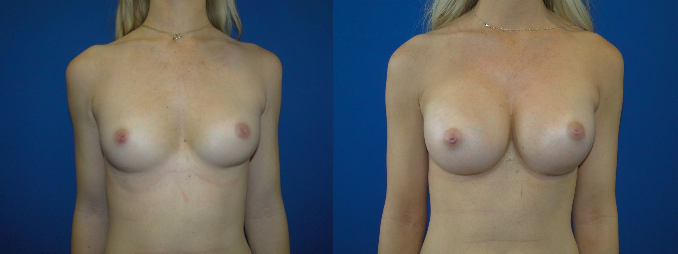 Breast Augmentation Before & After Gallery - Patient 74818583 - Image 1