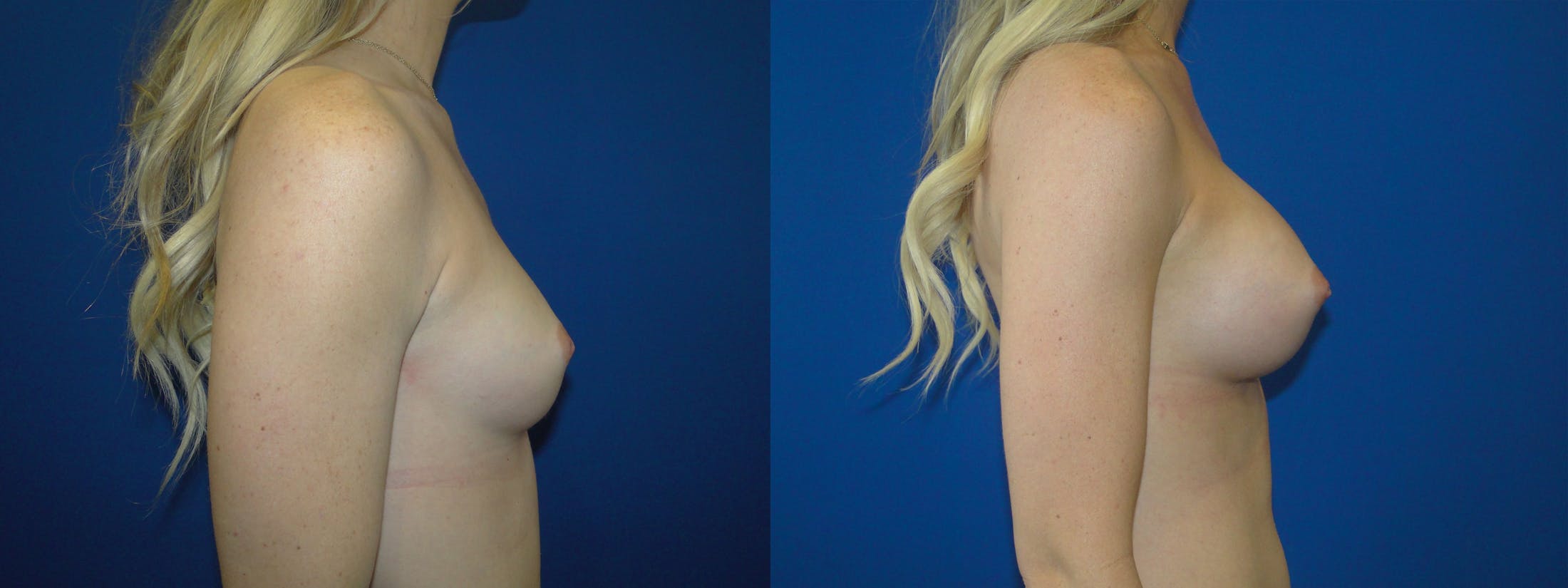 Breast Augmentation Before & After Gallery - Patient 74818583 - Image 2