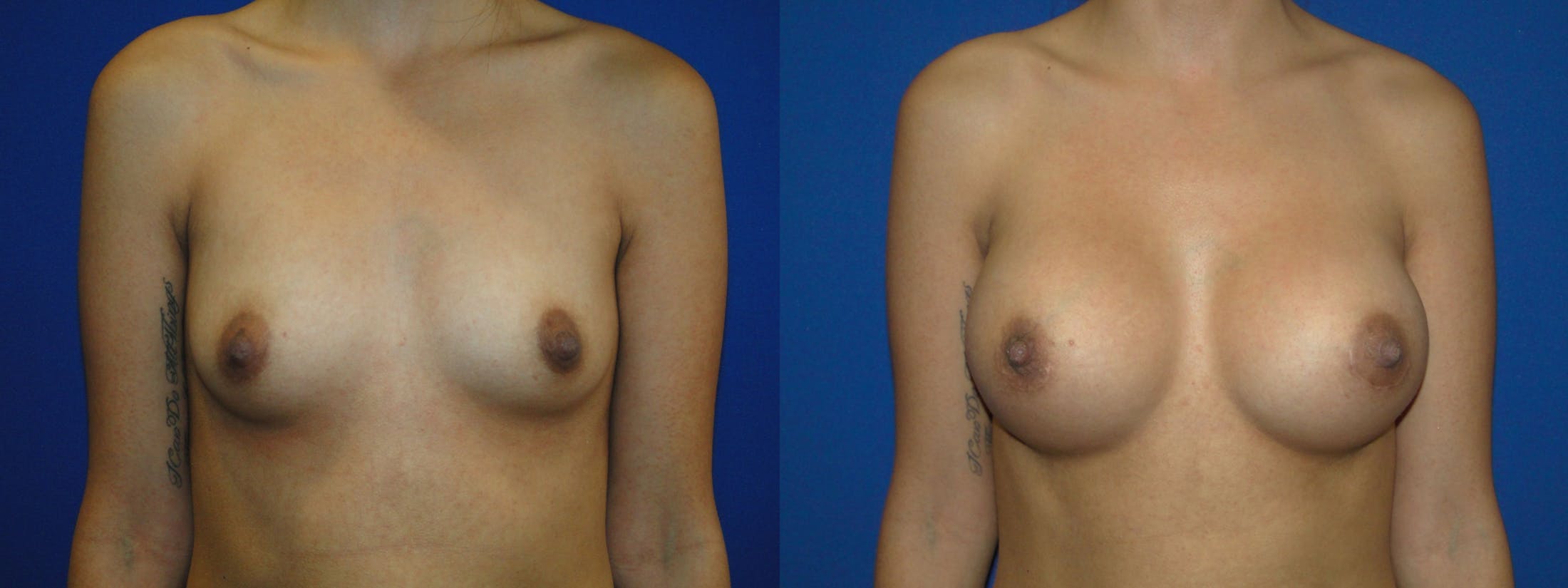 Breast Augmentation Before & After Gallery - Patient 74818584 - Image 1