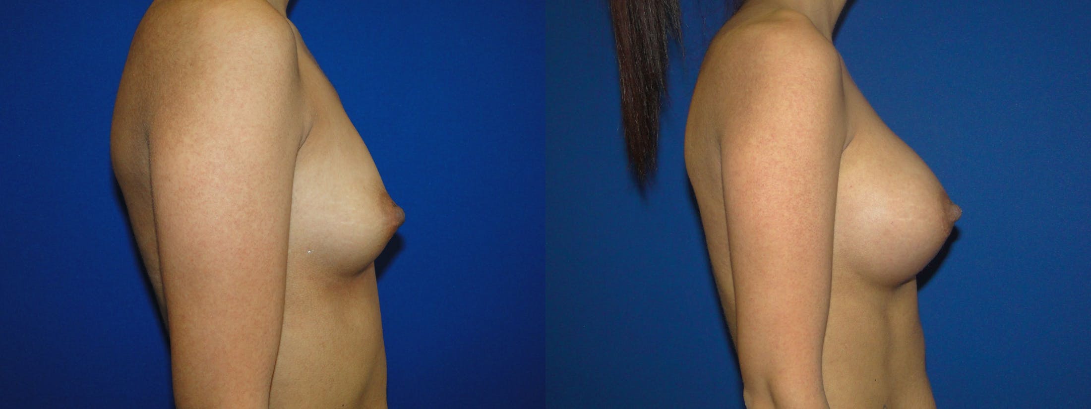 Breast Augmentation Before & After Gallery - Patient 74818584 - Image 2