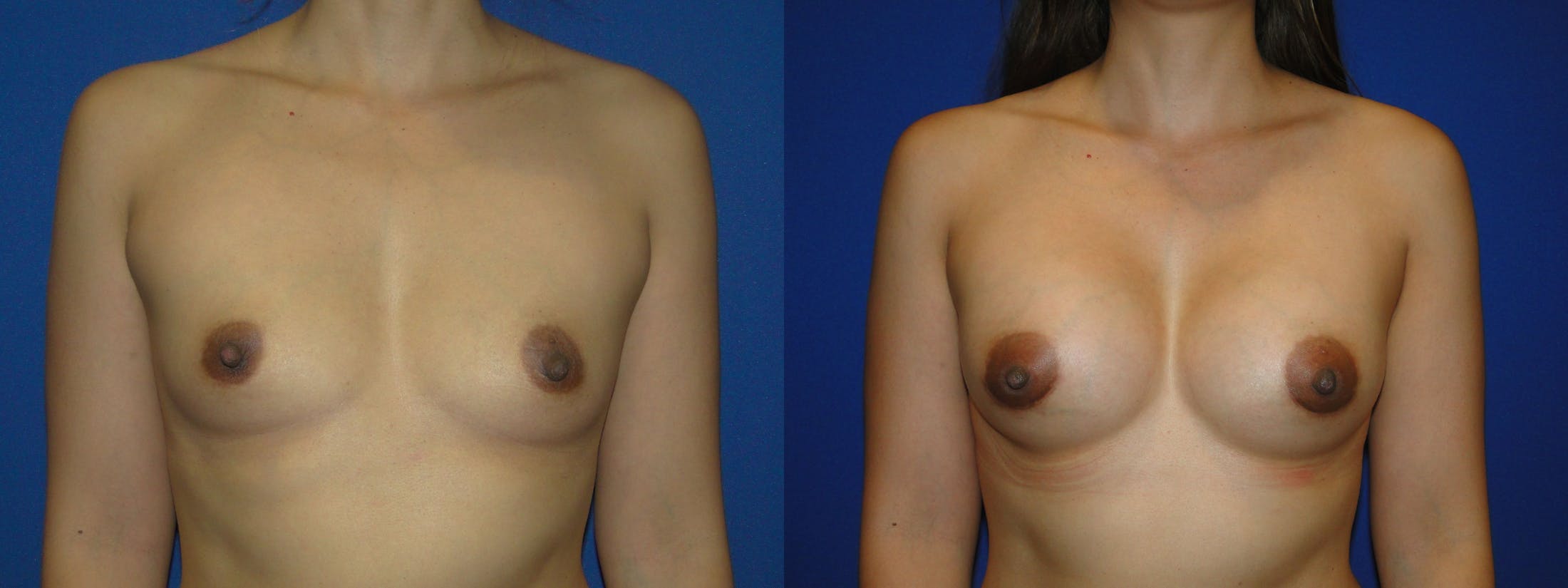 Breast Augmentation Before & After Gallery - Patient 74818586 - Image 1