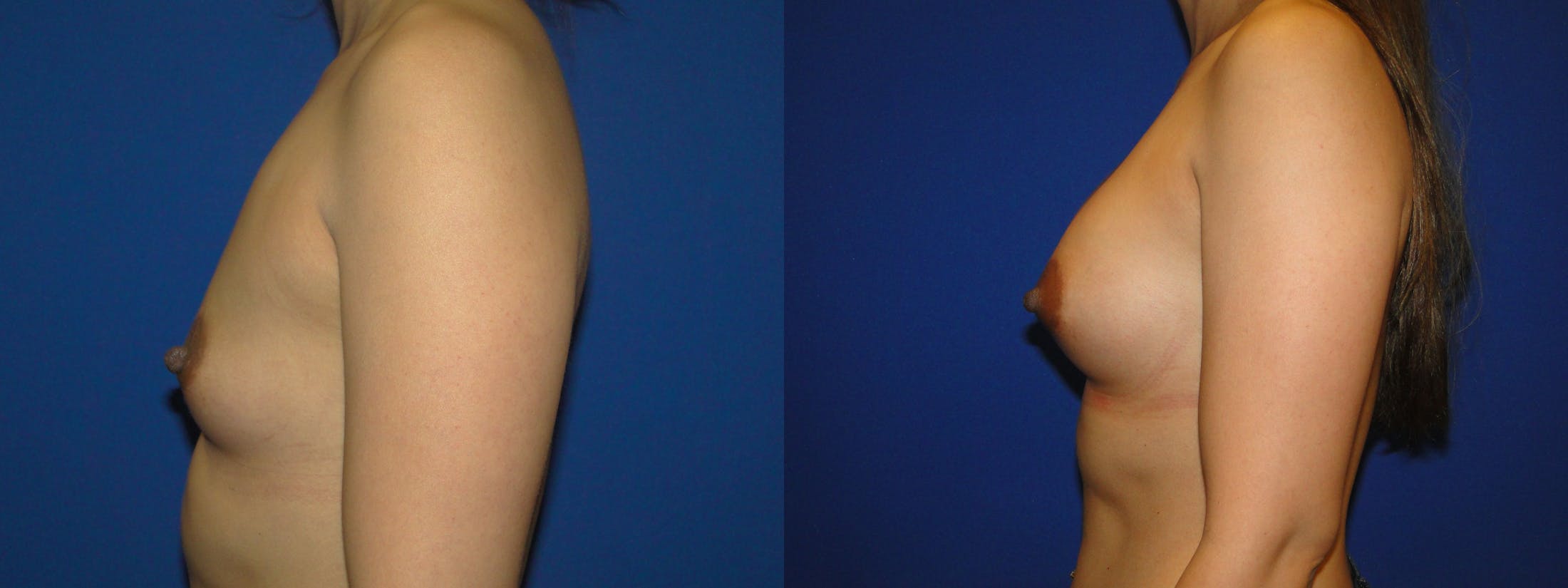 Breast Augmentation Before & After Gallery - Patient 74818586 - Image 2