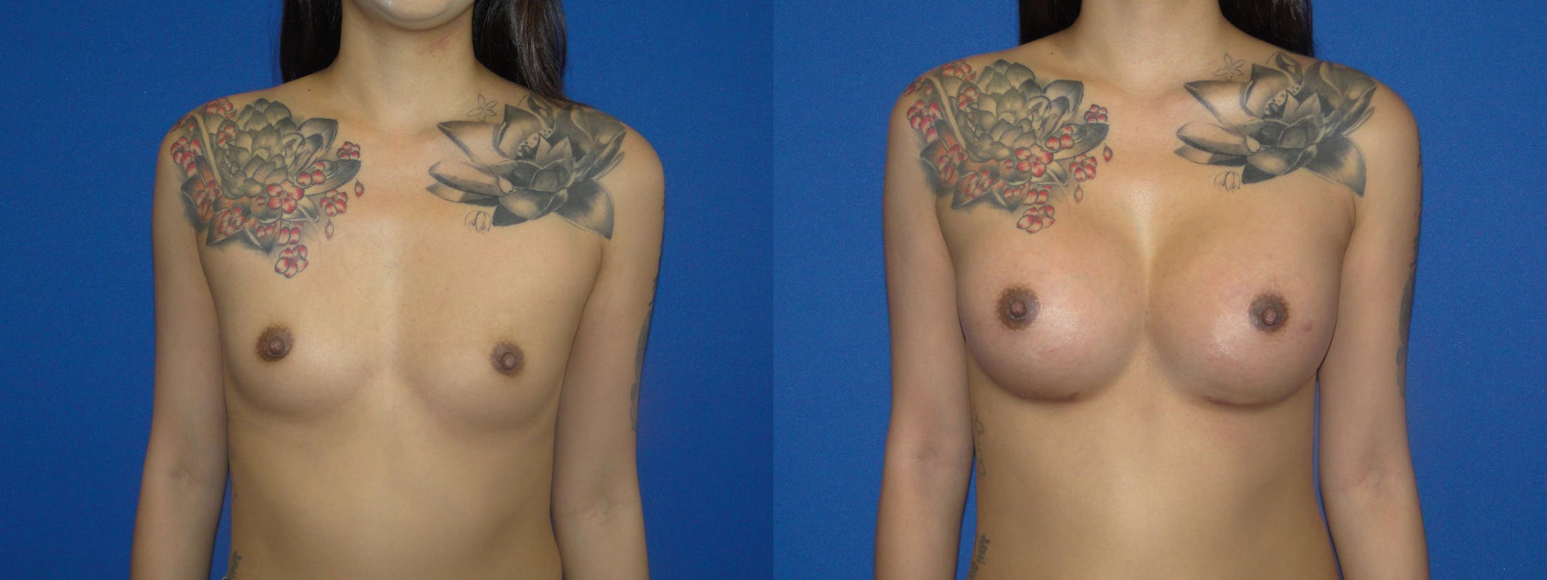 Breast Augmentation Before & After Gallery - Patient 74818587 - Image 1