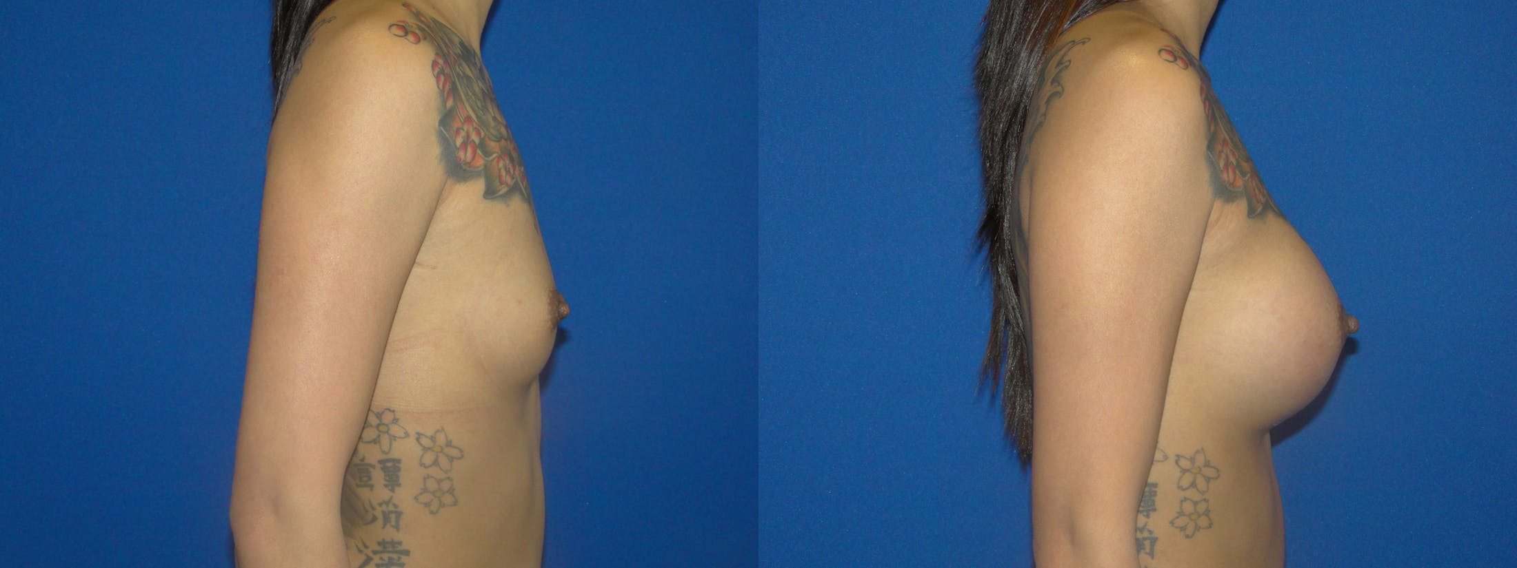 Breast Augmentation Before & After Gallery - Patient 74818587 - Image 2