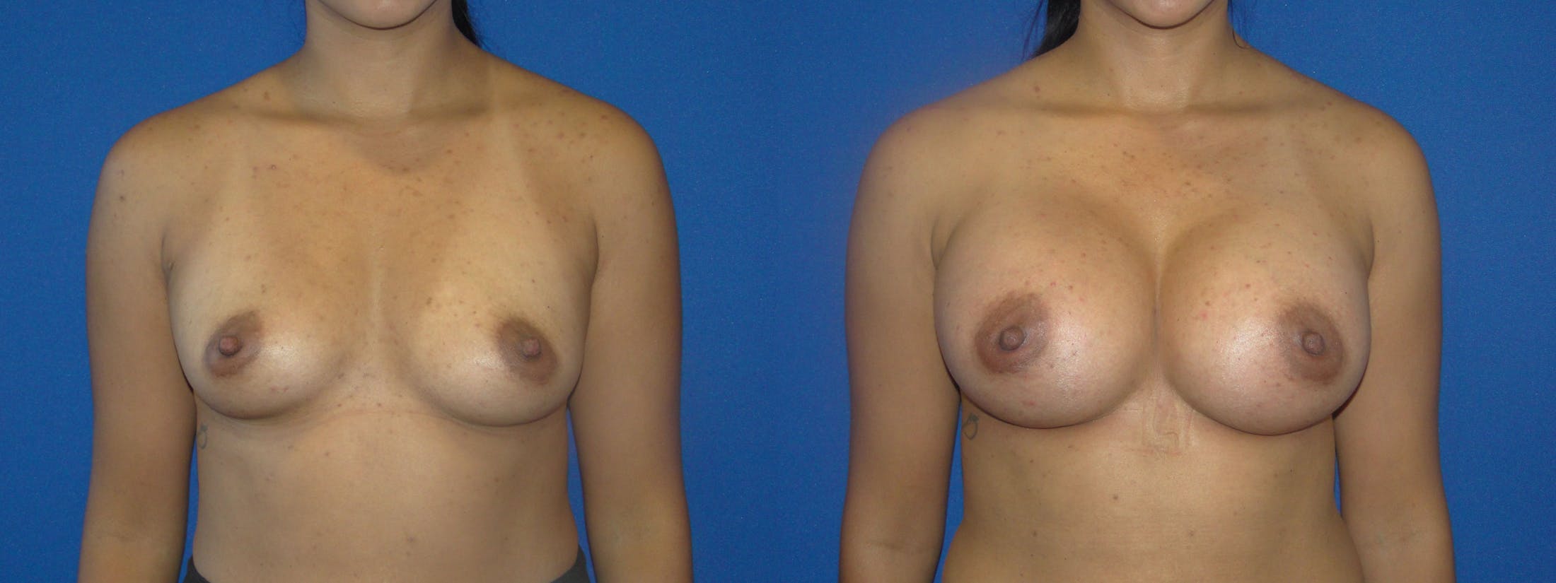 Breast Augmentation Gallery - Patient 74818589 - Image 1