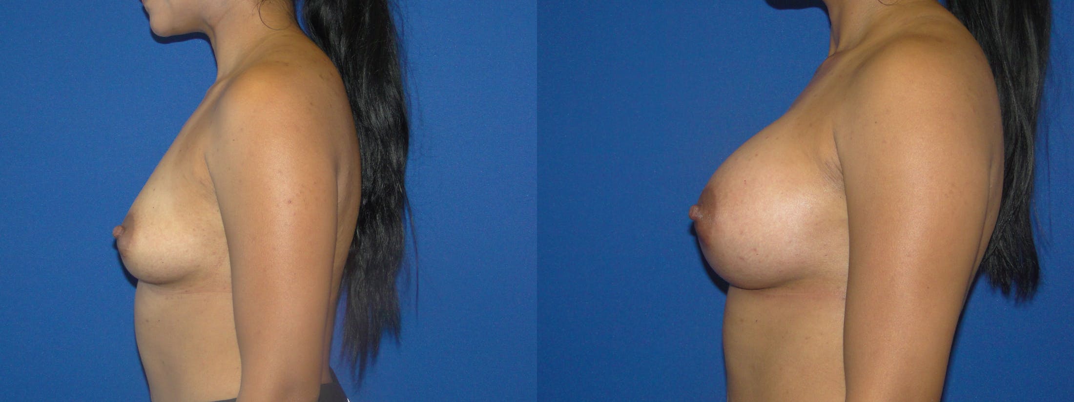 Breast Augmentation Before & After Gallery - Patient 74818589 - Image 2